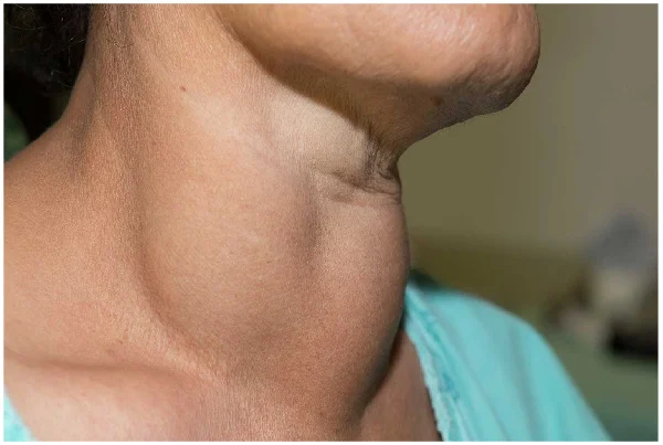 Thyroid